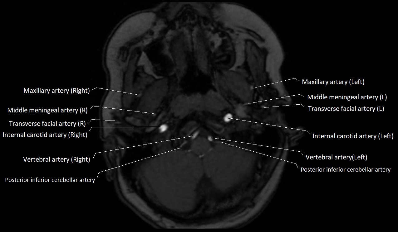 Carotid artery anatomy axial 3T image 1.jpg